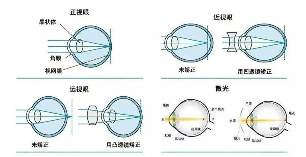 天顺平台：我去配了一副AI眼镜，发现近视不配用AI眼镜？